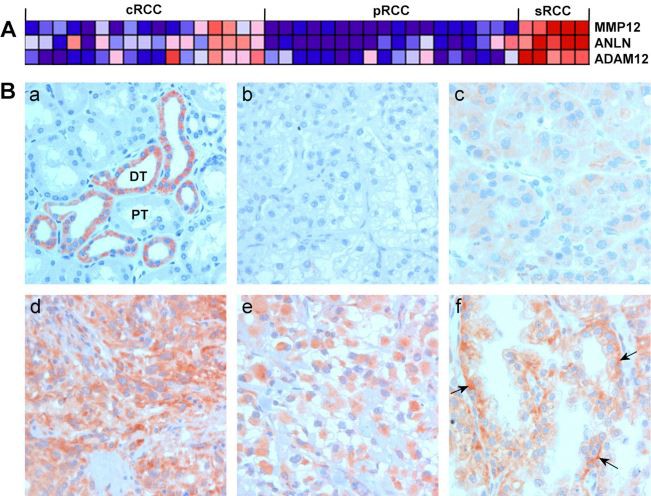  renal cell carcinoma